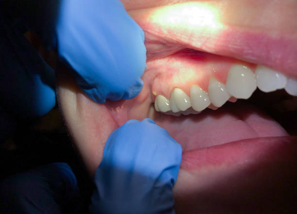 Best Emergency Dental Care for Broken or Chipped Teeth in England, AR